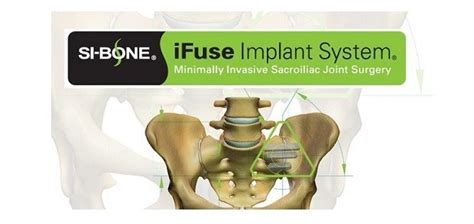 SI-BONE, Inc. Announces CIGNA Establishes Positive Coverage for MIS SI ...