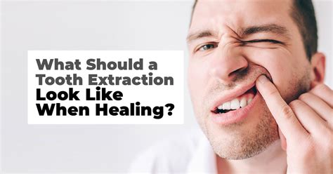 What To Do After Tooth Extraction : The extraction of a tooth is sometimes necessary when you ...