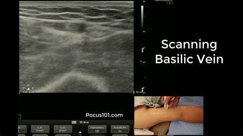 Scanning the Basilic Vein with Ultrasound - YouTube