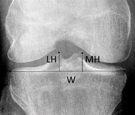 SAT0435 Tibial Spine Morphology and Association with Anterior Cruciate Ligament Degeneration – A ...