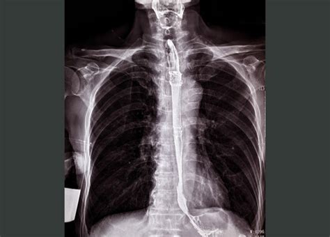 Stenting May Not Fully Resolve Refractory Esophageal Strictures in ...