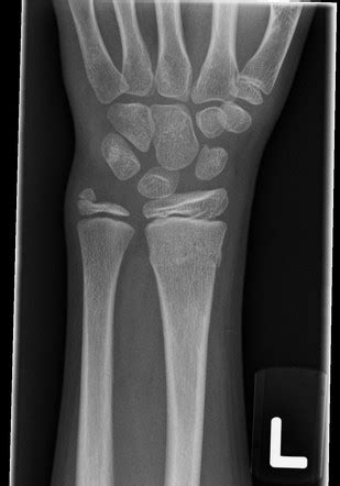 Ulnar Styloid Process Avulsion Fracture Radiology Case Radiopaedia Org | Hot Sex Picture