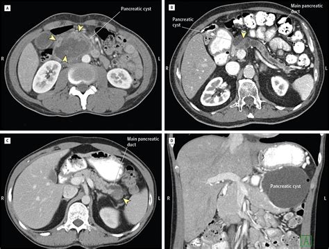 Pancreatic Cyst Disease: A Review | Gastroenterology | JAMA | JAMA Network