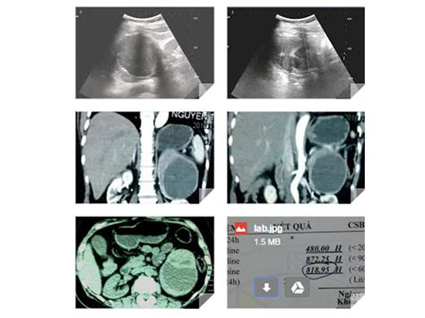 VIETNAMESE MEDIC ULTRASOUND: CASE 373: PHEOCHROMOCYTOMA, Dr PHAN THANH ...