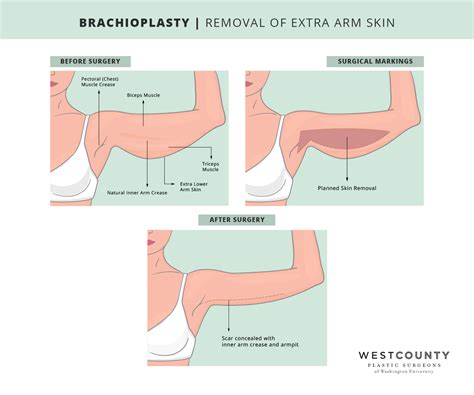 Arm Lift | St. Louis, MO | West County Plastic Surgeons