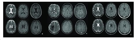 | MRI in the acute phase of NMOSD (A), tumefactive MS (B), and ischemic... | Download Scientific ...