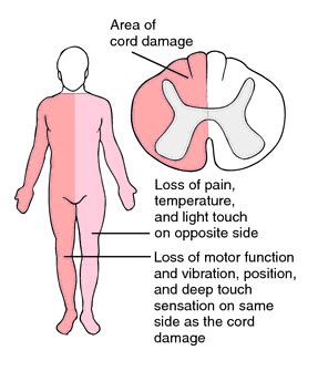 Spine Inflammation & Stem Cell Therapy for Transverse Myelitis