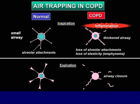 1 hypoventilation disorders