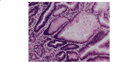 Histological images (H&E, × 100) showing foveolar hyperplasia with... | Download Scientific Diagram