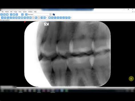 Incorrect horizontal angulation in bite-wing radiographs. - YouTube