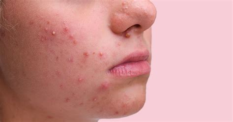 Fungal Acne: Causes And Treatment | Ova SG