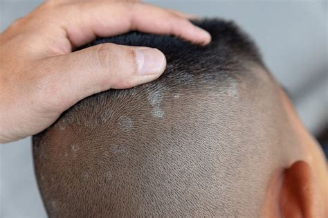 3 Signs Of Eczema On The Scalp - Hair Loss Topic