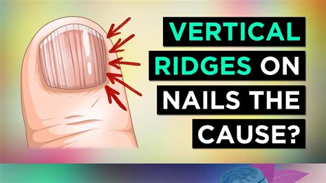 The REAL Causes of VERTICAL RIDGES On Your Nails - YouTube