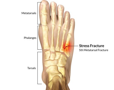 A New Classification Of Fifth Metatarsal Stress Fracture A Complete ...