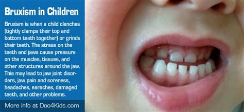 Treatment for Bruxism (TMJ) In Children - Doc4Kids.com