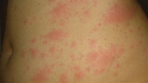 Rash With Covid - What Effects Covid-19 Can Have On Your Skin Wellness Attic