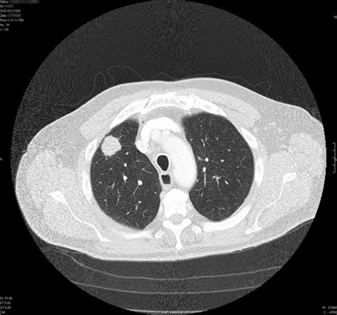 CT Screenings Aid in Early Lung Cancer Detection – Bluegrass Regional Imaging