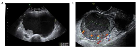 The characteristic ultrasound features of specific types of ovarian pathology (Review)