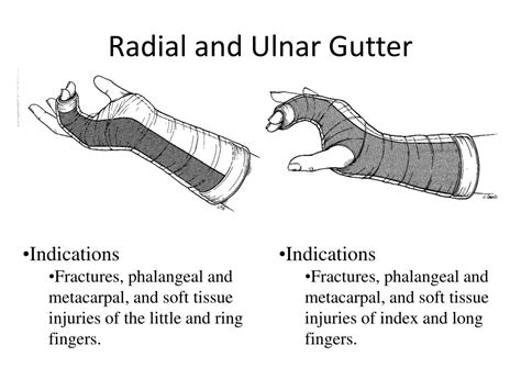 Ulnar Gutter Splint