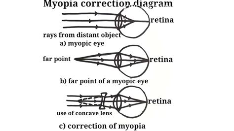 Myopia correction diagram / how to draw myopia correction diagram ...