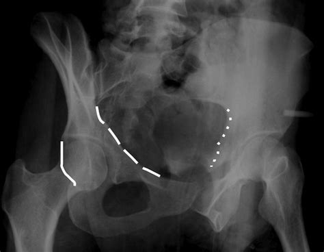 Acetabular Fractures: Anatomic and Clinical Considerations | AJR