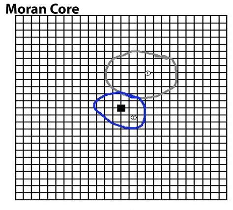 Moran CORE | Central Serous Chorioretinopathy – Case Report