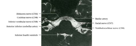 My Radiology Files: CRANIAL Nerves MRI Anatomy