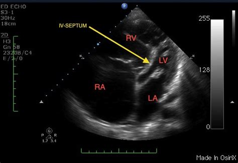 Right Heart Strain ~ Ultrasound Cases Info