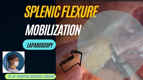 Laparoscopic Splenic Flexure Mobilization: Step by Step - YouTube