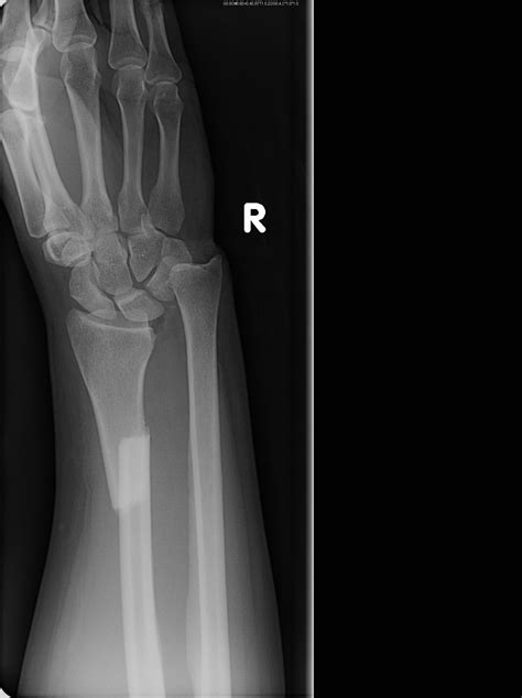 Galeazzi fracture | Image | Radiopaedia.org