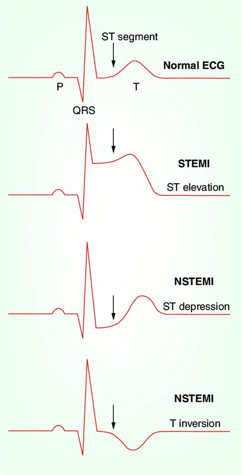 NSTEMI Vs STEMI On EKG