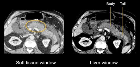 Abdominal CT: necrotizing pancreatitis • LITFL • Radiology Library