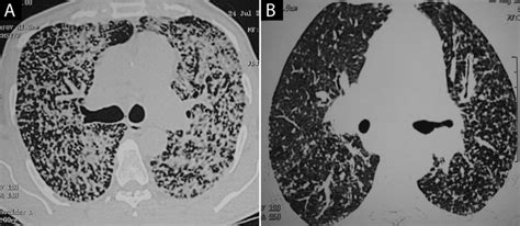 Bronchoscopic Lung Biopsy Using Noninvasive Ventilatory Support: Case Series and Review of ...