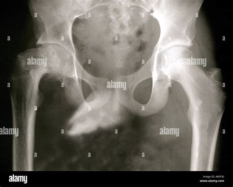 Slipped capital femoral epiphysis hi-res stock photography and images ...