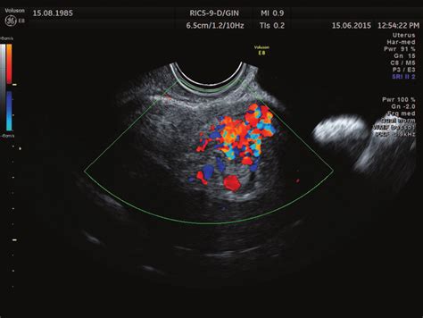 Abnormal Transvaginal Ultrasound Color Doppler Pictures To | My XXX Hot ...