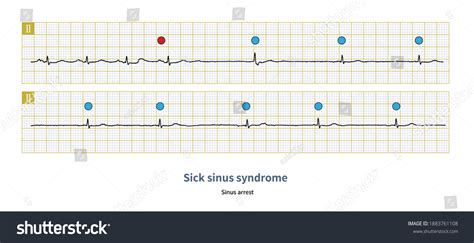 In sick sinus syndrome, sinus arrest can lead to - Royalty Free Stock Photo 1883761108 - Avopix.com