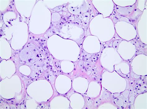 Fat Necrosis Histology