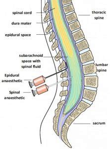 Spinal & Epidural Anaesthetics | Labour & Delivery Pain Relief