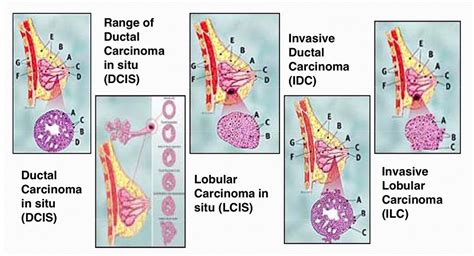 Breast Cancer - Timberland Medical Centre