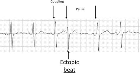 Ectopic Beats - Cardiac Electrophysiology Clinics