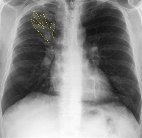 Finger in glove sign (annotated) Allergic bronchopulmonary aspergillosis (ABPA) | Radiology Case ...