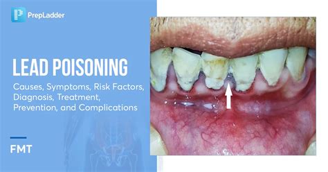 Lead Poisoning: Causes, Symptoms, Risk Factors, Diagnosis