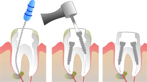 How to Find the Right Root Canal Specialist for Your Needs