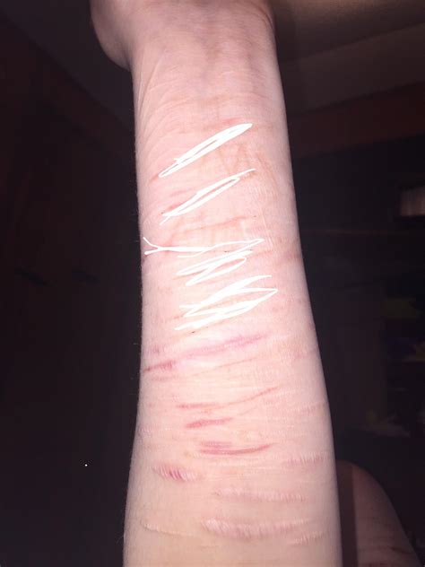 Scars on left arm, marked out the recent ones : r/SelfHarmScars