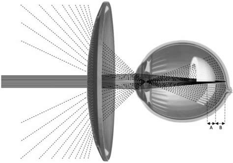 Understanding the new Essilor® Stellest® spectacle lens | Myopia Profile