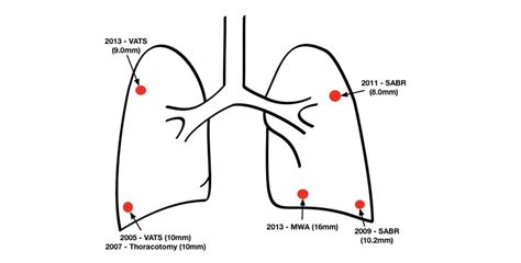 Lung Cancer: Treatments For Lung Cancer Stage 3