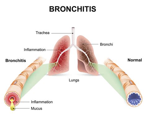 Treatment for Bronchitis - Philadelphia Homeopathic Clinic