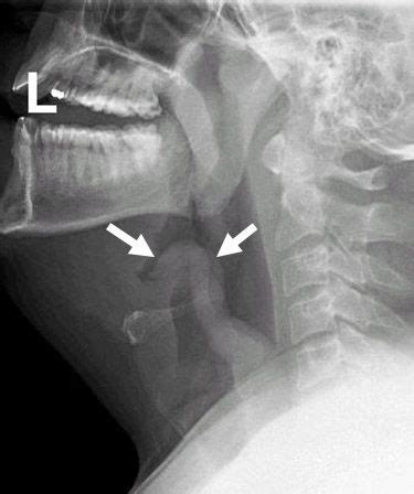 epiglottitis x ray - CindyteMckenzie