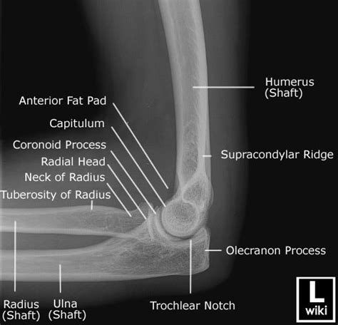 Lateral radiograph of the elbow with labels. | Medical anatomy ...