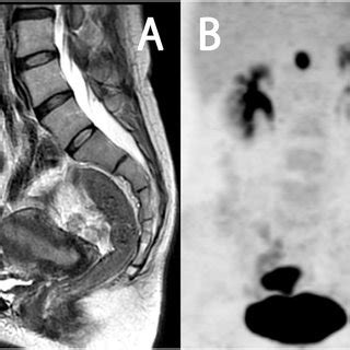 Paraaortic lymph node dissection via a retroperitoneal approach. The ...